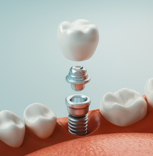 Illustrated dental implant with crown being placed into the lower jaw