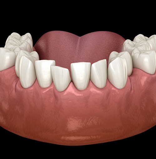 Example of tooth crowding in Colorado Springs