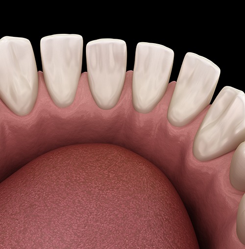 Example of tooth gaps in Colorado Springs