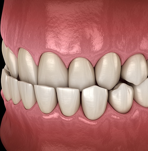  Example of underbite in Colorado Springs