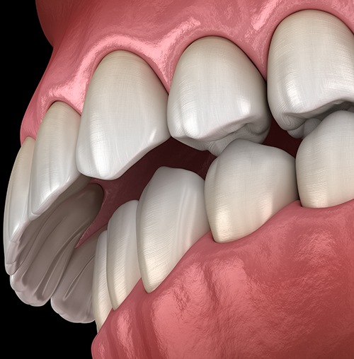  Example of overbite in Colorado Springs
