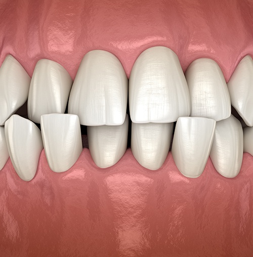  Example of crossbite in Colorado Springs