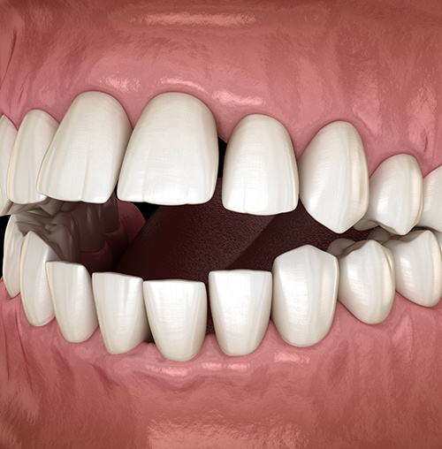  Example of open bite in Colorado Springs