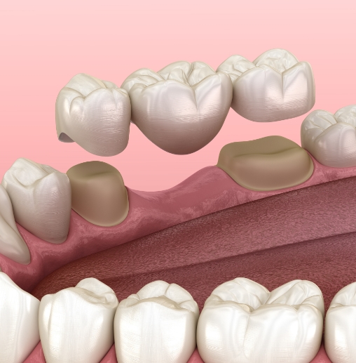 Illustrated dental bridge being fitted to replace a missing tooth