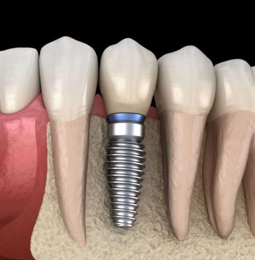 Illustrated dental implant in the lower jaw replacing a missing tooth