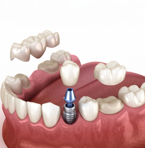 Illustrated row of teeth receiving a dental crown a dental bridge and a dental implant