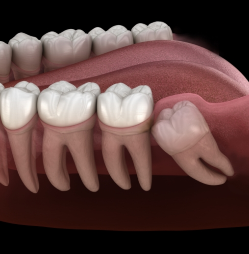 Illustrated impacted wisdom tooth pressing against molar
